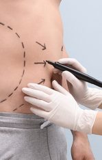 best liposuction in Lahore