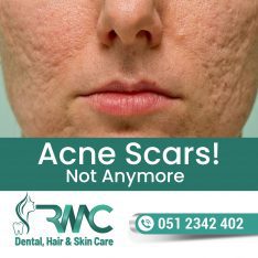 Best Acne Scars Removal Treatment in Islamabad – Rehman Medical Center