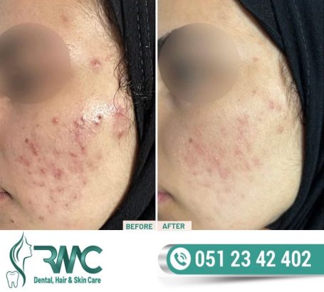 Laser Treatment For Acnes cars in Islamabad – Acnes cars Removal in Islamabad – Best Acnes cars Removal Clinic In Islamabad – Best Treatment For Acnes cars In Islamabad – Acne Scars Removal In ISB