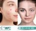 Laser Treatment For Acnes cars in Islamabad – Acnes cars Removal | RMC