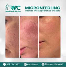 Microneedling Therapy in Islamabad-Best Microneedling Treatment I RMC