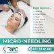 Microneedling Therapy in Islamabad-Best Microneedling Treatment I RMC