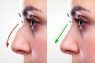 Rhinoplasty In Lahore