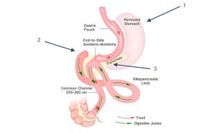 SADI Bypass Surgery in Pakistan – ALSA Pakistan