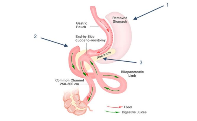 SADI Bypass Surgery in Pakistan – ALSA Pakistan